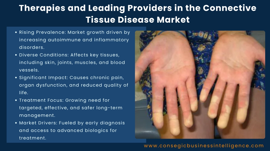 Therapies and Leading Providers in the Connective Tissue Disease Market Blog